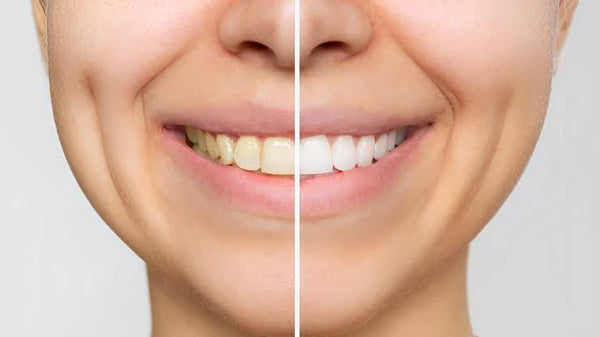 Sonrisa Blanca en Minutos