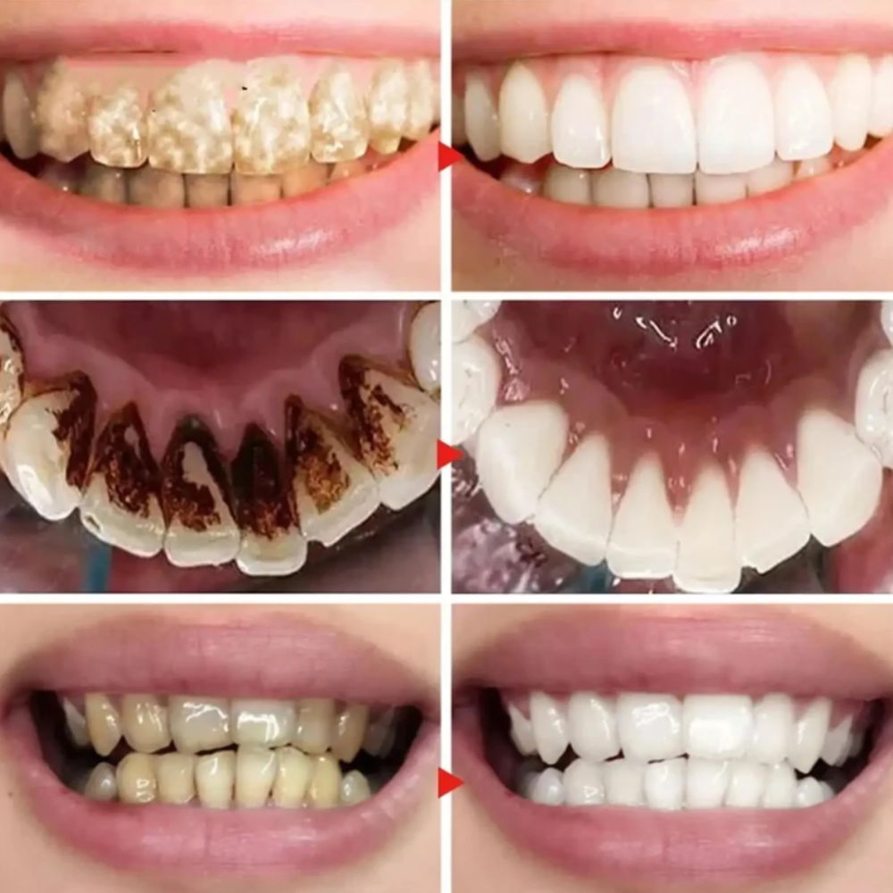 Blanqueador Dental Lila Flash V34 - Sonrisa blanca en minutos